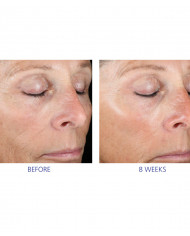 Dvoukrokový peelingový systém  Active Peel System