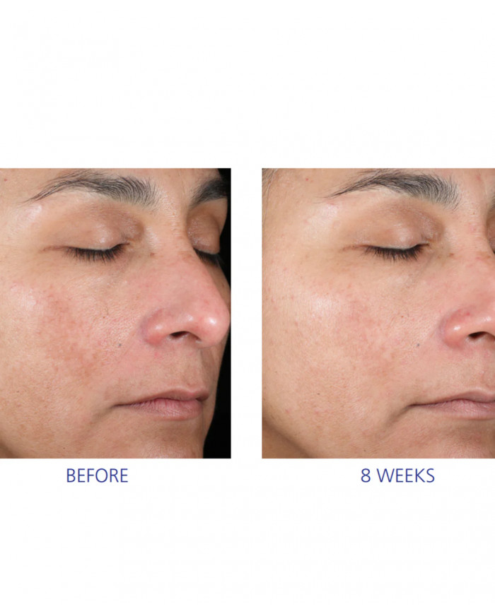 Dvoukrokový peelingový systém  Active Peel System