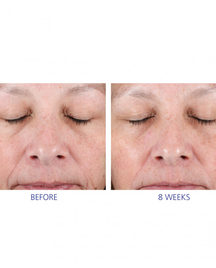 Dvoukrokový peelingový systém  Active Peel System