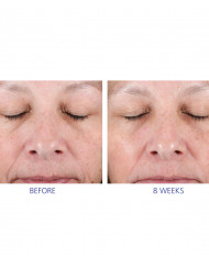 Dvoukrokový peelingový systém  Active Peel System