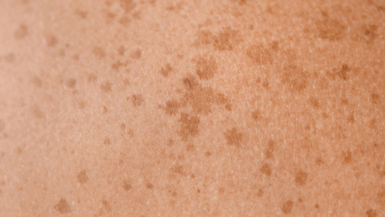Trápí vás pigmentové skvrny?